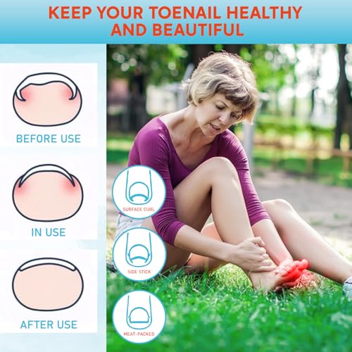 Ginger Ingrown Toenail Treatment, Professional Ingrown Toenail Removal Kit at Home, Ingrown Toenail Tool with Ingrown Toenail Corrector, Corrector Patch, Toenail Clipper, Nail File Lifter