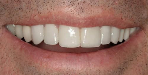 DIY Dentures, Customizable Kit with 12 Pieces, Simple to Use. Dentures Upper and Lower, Home Denture Solution for an Ideal Smile, Women and Men