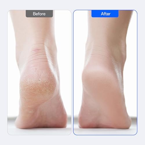 FSA&HSA Eligible Electric Foot Callus Remover with 60pcs Sandpaper Discs, Professional 1200RPM Aluminum Callus Remover for Feet, Stepless Speed Control Foot File for Dead Skin (Black)