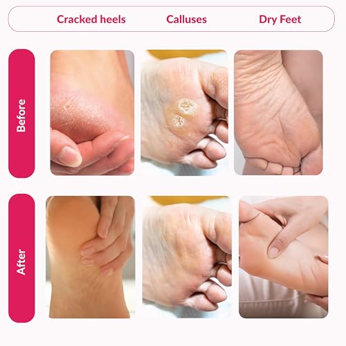 Peeling Mask That Removes Dead Skin - Dermatologically Tested Callus Remover for Dry Cracked Feet - Exfoliating Foot Peel Mask for Baby Soft Feet - 2 Pack with Cucumber & Urea Extracts