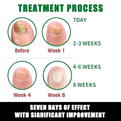 Ginger Nail Treatment Nail Support Nail Care, 7Days Nail Treatment Serum, Multi-Purpose Nail Repair