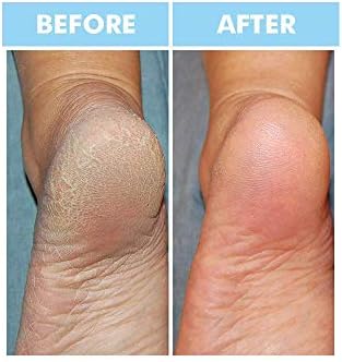 Bodipure Premium Hand and Foot Mask | Moisturizing Kertain Gloves & Socks | Hydrating Dull Dry Hands, Cracked Heels, Callus Softening & Nail Strengthening | Chemical-Free Feet Treatment | (6+6 Pack)