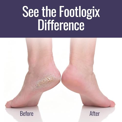 Footlogix Foot Care Callus Softener Combo - Callus Remover Spray & Double-Sided Foot File for Dry, Cracked Heels, Pedicure Tools for Feet, Foot Exfoliator
