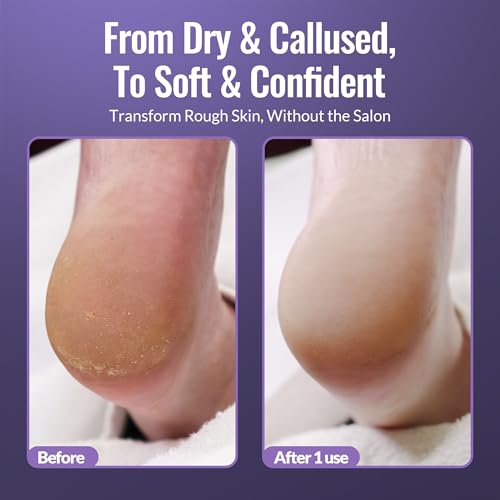 Footlogix Foot Care Callus Softener Combo - Callus Remover Spray & Double-Sided Foot File for Dry, Cracked Heels, Pedicure Tools for Feet, Foot Exfoliator