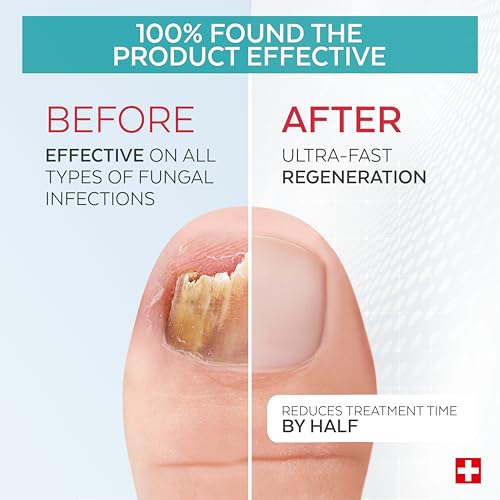 PODERM – TOENAIL RENEWAL BOOSTER – TEA TREE oil-serum - Restores Appearance of Discolored/Damaged Nails – Toe and Fingernail Repair – 100% Natural Ingredients and Vegan – Express Renewal – Swiss Made