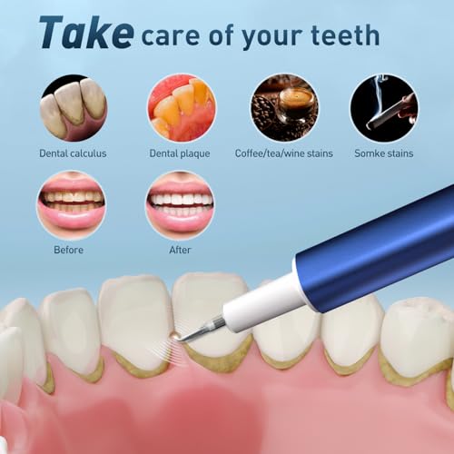 Dental Calculus Remover, Ultrasonic dental calculus remover for Teeth Cleaning with 4 Replaceable Heads and 3 Adjustable Modes