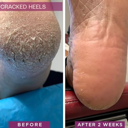 Rapid Crack Repair Cream, 25% Urea with Lactic Acid, Heals Cracked Heels and Diabetic Feet, Post-Surgery Scar Care, Fragrance-Free Barrier Cream, 3 oz