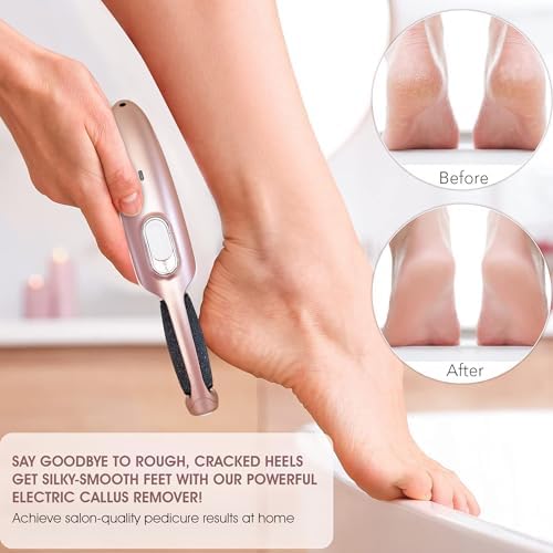 Powerful Electric Callus Remover Wand – Rechargeable Foot File, Grinder & Scrubber - Removes Dead, Hard Skin & Calluses – Best Pedicure Tool for Soft, Smooth Feet for Men & Women (Rose Gold)
