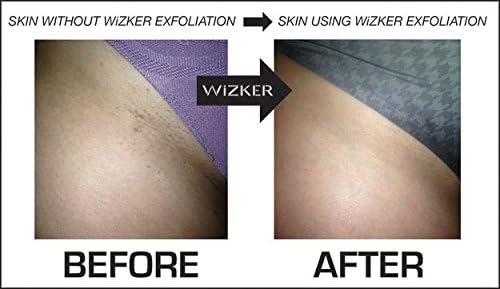 WIZKER® Premium Ingrown Hair Exfoliating Brush: Soft + Firm Face Body Scrubber, Sensitive Skin Exfoliator, Prevents Razor Bumps, Shave, Laser, Wax, Epilation, Dermaplaning – Waterproof, Mold Resistant