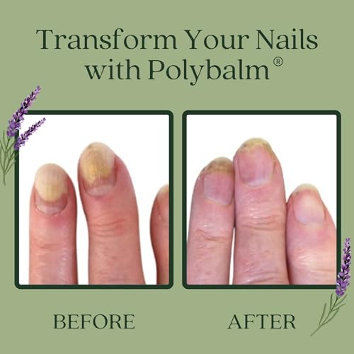 Nail Care – 100% NATURAL, Helps to Prevent, Protect & Strengthen Chemo Nails & Damaged Nails. Formulated by Dermatology, Cancer & Botanical Experts.