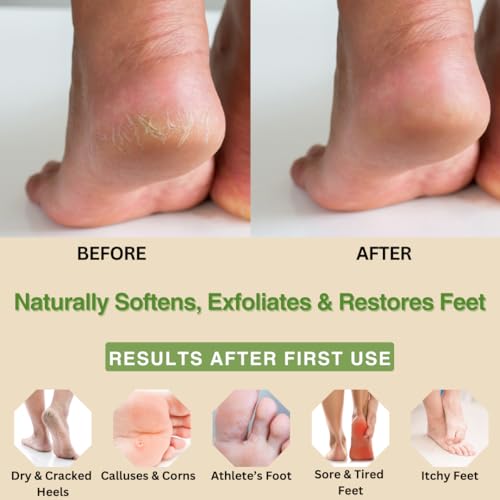 Peppermint + Rosemary, Eucalyptus & Tea Tree Foot Cream for Dry Cracked Heels and Feet - Moisturizing Foot Lotion for Cracked Heel Repair - Callus Remover with Lactic Acid (4 oz)