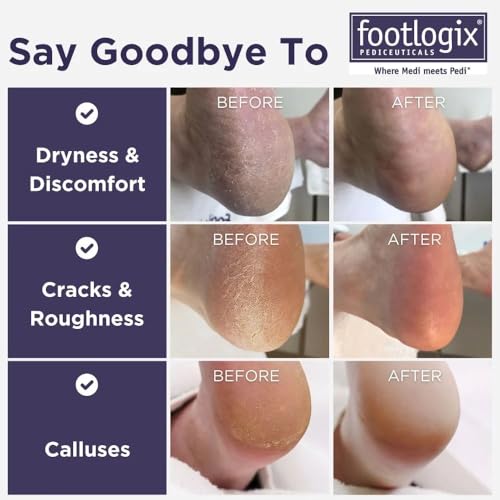 Foot Care Callus Softener - Footlogix Callus Softener Spray & Double Sided Foot File Set for Dry, Rough, Cracked Heel - Feet Exfoliator & Scrubber for Convenient Pedicure at Home