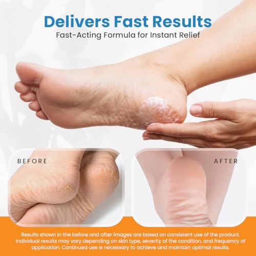 Revitaderm 4D Urea Cream 40 Percent for Feet Maximum Strength, for Dry Hands, Elbows and Knees, Callus Remover for Feet, Free Pumice Stone, 4oz, 1 Pack