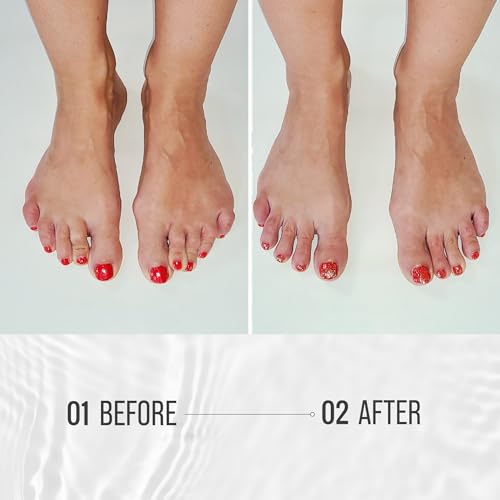 TRIHARD Toe Spacers | Foot Alignment & Bunion Relief | One Size Silicone Yoga Toe Separators & Post-Run Toe Corrector for Mobility & Pressure Relief