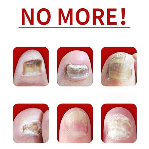 Ginger Nail Treatment Nail Support Nail Care, 7days Nail Treatment, Ginger Nail Growth Serum, Ginger Cuticle Care Oil for Nails,Cuticle Serum for Nails (3Pcs, 1 Fl.oz(pack of 1))