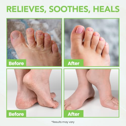 THENA Athlete’s Foot Treatment Balm Extra Strength with Tea Tree Peppermint Neem, Powerful Natural Anti-Itch Foot & Skin Cream Soothes & Relieves Itchy, Dry, Cracked Feet, Heels, Toenails, Jock Itch