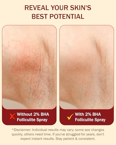 Folliculitis Treatment 2% BHA Body Spray - Salicylic Acid with Tea Tree Oil & Aloe Vera - Spray Moisturizer for Dry Skin, Clogged Pores & Irritation by Made in USA, 4 fl. oz