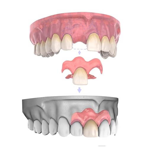 Custom Partial Dentures Removable Dentures, Portable Dental Prosthetics for Teeth (1 Tooth)