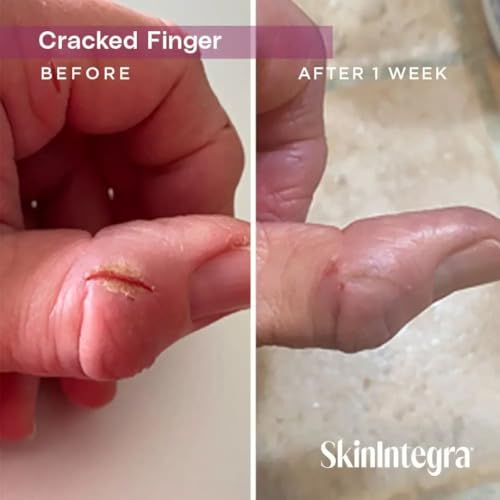 Rapid Crack Repair Cream, 25% Urea with Lactic Acid, Heals Cracked Heels and Diabetic Feet, Post-Surgery Scar Care, Fragrance-Free Barrier Cream, 3 oz