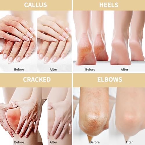 Urea Cream 50 Percent for Feet Maximum Strength 5.29 oz with Oat and 2% Salicylic Acid, Foot & Hand Cream included Hyaluronic Acid, Tea Tree and Aloe Vera for Deep Moisturizing, Callus Removing