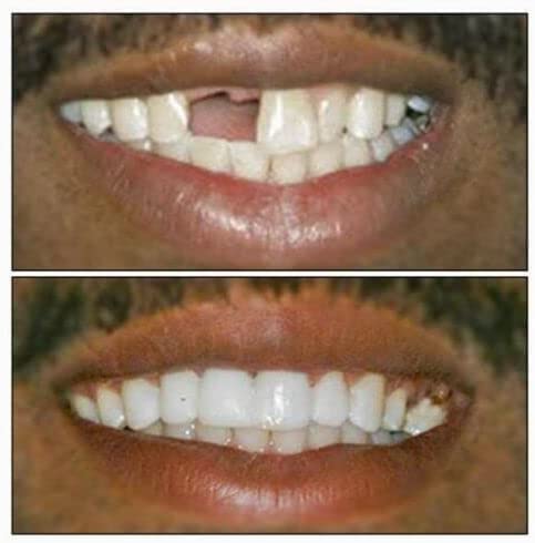 Dentemp Recap-It Cap and Crown Repair Dental Kit - Fast Acting Formula Dental Cement for Loose Caps (Pack of 3) - Temporary Cement for Crown and Bridge