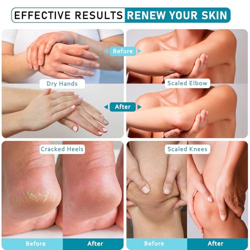 Urea Cream 40 Percent For Feet Maximum Strength - plus Salicylic Acid 2% Foot Cream For Dry Cracked Heels Feet Knees - Dead Skin Cuticle Callus Remover Toenail Softener