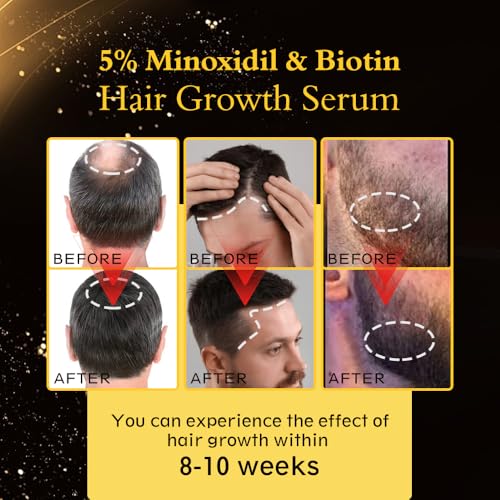 5% Minoxidil Hair Regrowth Oil for Men and Women – Extra Strength Topical Serum for Hair Loss, Promotes Thicker, Healthier Hair and Beard Growth Kit, 2.11 fl.oz
