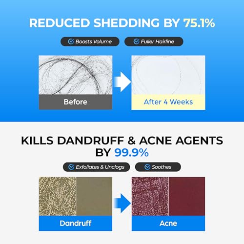 Scalpy Anti Dandruff Bubble Treatment Tonic | for both Men & Women | Itchy Scalp Treatment with Salicylic Acid, Menthol, Dexpanthenol | Non-Greasy, Lightweight for Hair loss & Thinning