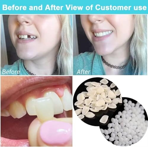 Fake Tooth Repair kits for Filling The Missing Broken Tooth and Gaps-Moldable and False Teeth Thermal Beads Replacement Kits