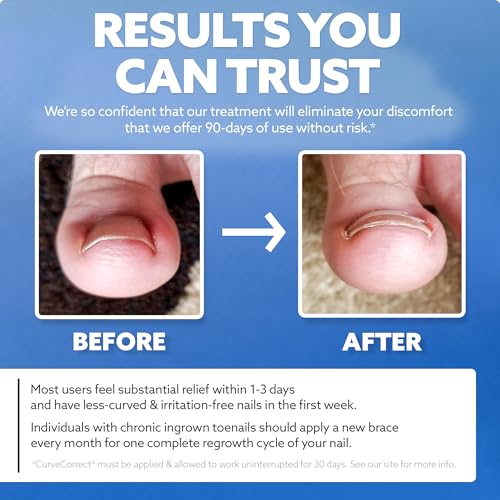 CurveCorrect® Ingrown Toenail Treatment Kit - Ingrown Toenail Corrector Kit with 10 Braces - at Home Ingrown Toenail Correction - Big Toe Ingrown Nail Treatment