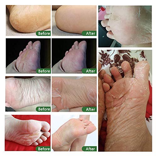 Foot Peeling Mask - 5 Pack, Exfoliating Mask Make Feet Baby Soft, Foot Mask for Dry Cracked Skin, Peeling Away Dead Skin, Calluses - Lavender