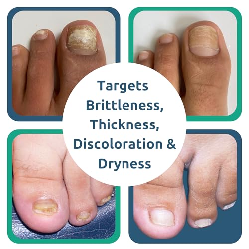 Nail Renewal Gel, Discoloration, Thick, Brittle, Cracking Nails, Clippers Included - 1.25 fl. oz.