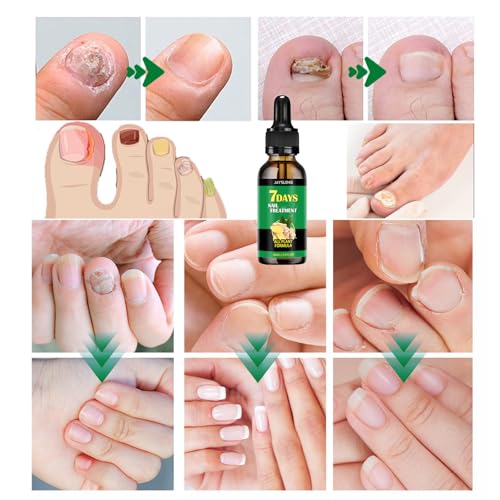Ginger Nail Treatment Nail Support Nail Care, 7days Nail Treatment, Ginger Nail Growth Serum, Ginger Cuticle Care Oil for Nails,Cuticle Serum for Nails (3Pcs, 1 Fl.oz(pack of 1))