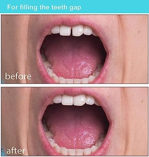 Fake Tooth Repair kits for Filling The Missing Broken Tooth and Gaps-Moldable and False Teeth Thermal Beads Replacement Kits