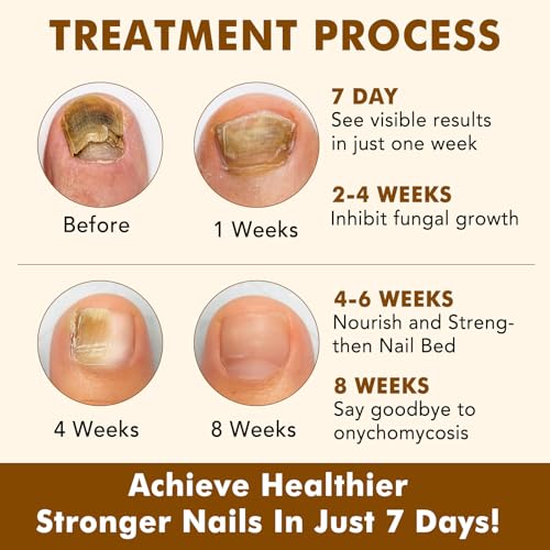 Ginger Nail Treatment, Nail Growth Serum, Nail Repair & Strengthening Oil, Ginger Cuticle Care Oil, Deep Hydration & Nourishing Support for Healthy Nails, 30ml, 2PCS