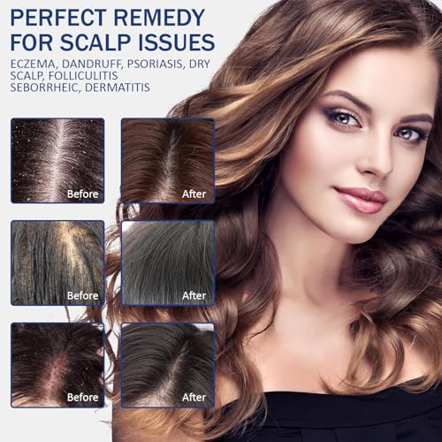 Sulfate Free - Anti Fungal Folliculitis Treatment Shampoo With Formula for Prone to Folliculitis,Seborrheic Dermatitis,For Normal to Oily Scalp Relieves Itchy & Dry Scalp, Dandruff - 10.1 Oz