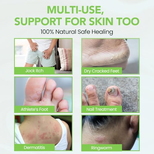 THENA Athlete’s Foot Treatment Balm Extra Strength with Tea Tree Peppermint Neem, Powerful Natural Anti-Itch Foot & Skin Cream Soothes & Relieves Itchy, Dry, Cracked Feet, Heels, Toenails, Jock Itch
