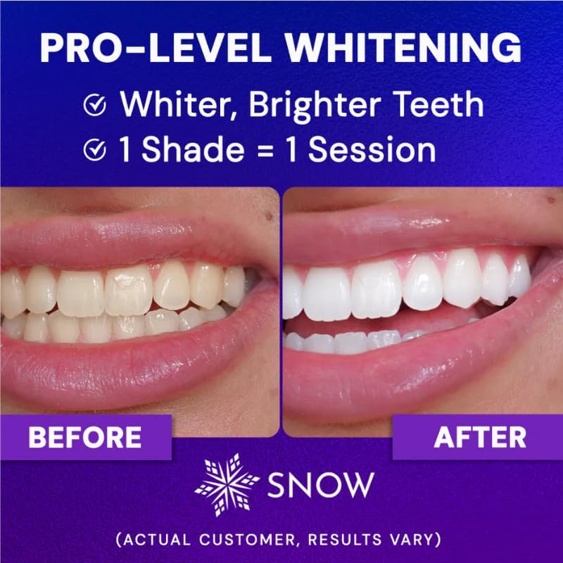 Snow Diamond Series Teeth Whitening Kit, 75+ Treatments, for Sensitive Teeth, Advanced Whitening Serum