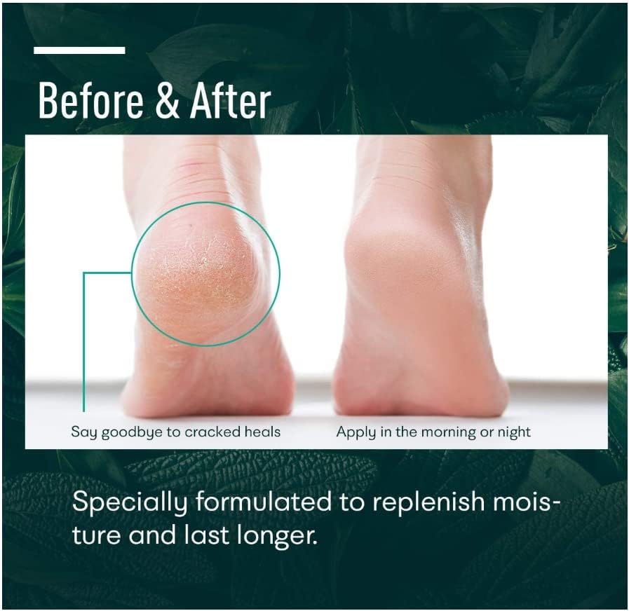 Urea cream 40 perent for feet: Maximum Strength Urea lotion for cracked Heels and Rough Thick Skin for foot- 42% Crema 5.29 oz.