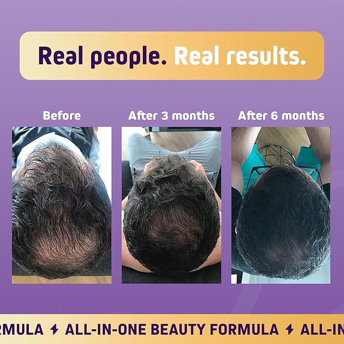 Herbtonics Foli Biotin Gummies with Hair Vitamins | Hair Growth Supplement for Women & Men | Hair, Skin and Nails Vitamins Sugarfree Gummies for Women | 60 Count